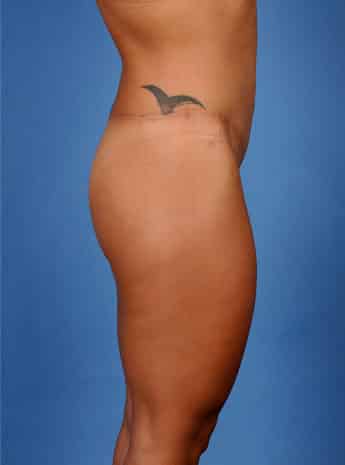 After Image: Body Lift - right-side