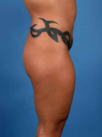 Before Image: Body Lift - right-side