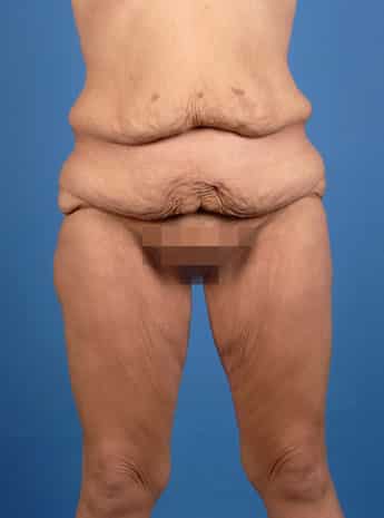 Before Image: Body Lift - front