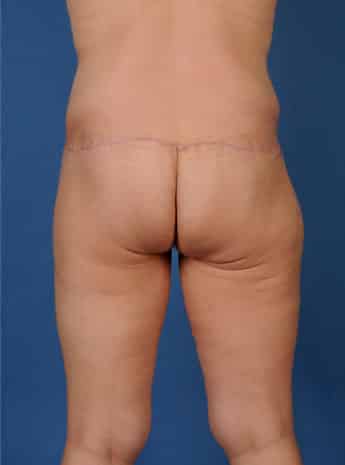 After Image: Body Lift - back