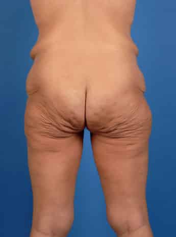 Before Image: Body Lift - back