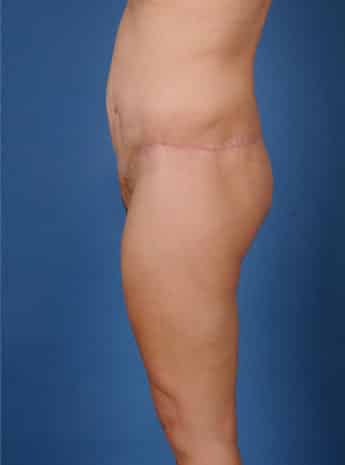 After Image: Body Lift - left-side
