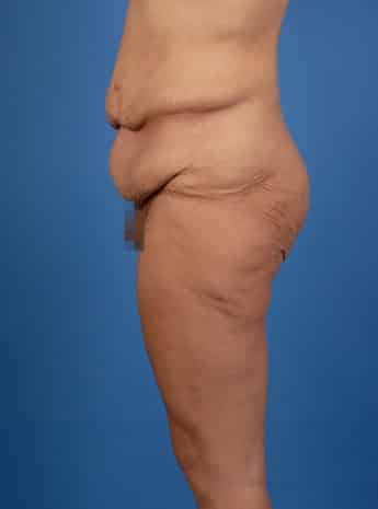 Before Image: Body Lift - left-side