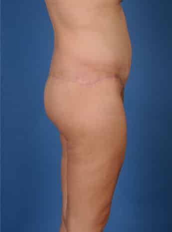 After Image: Body Lift - right-side