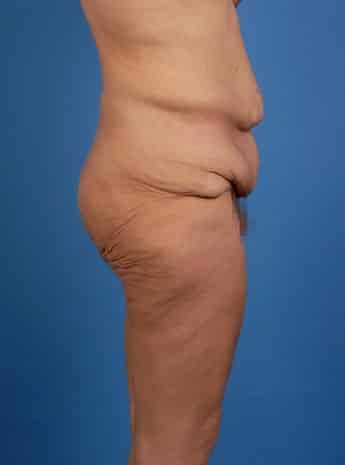 Before Image: Body Lift - right-side