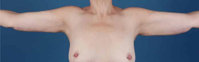 After Image: Brachioplasty (Arm Lift) - front