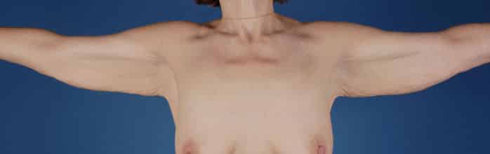 Before Image: Brachioplasty (Arm Lift) - front