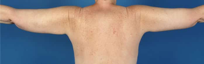 After Image: Brachioplasty (Arm Lift) - back