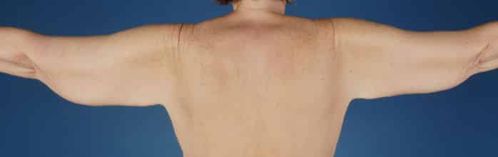 Before Image: Brachioplasty (Arm Lift) - back