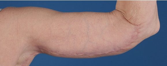 After Image: Brachioplasty (Arm Lift) - front