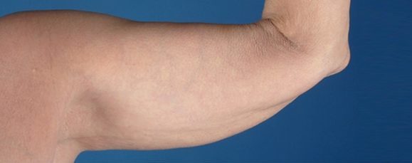 Before Image: Brachioplasty (Arm Lift) - front
