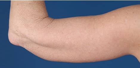 After Image: Brachioplasty (Arm Lift) - back