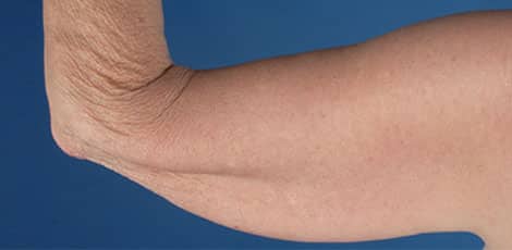Before Image: Brachioplasty (Arm Lift) - back