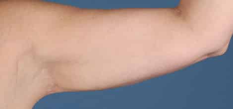 After Image: Brachioplasty (Arm Lift) - front