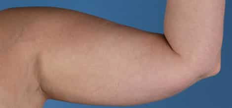Before Image: Brachioplasty (Arm Lift) - front