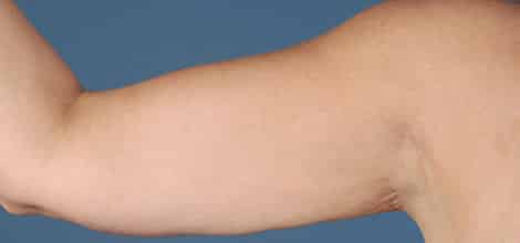 After Image: Brachioplasty (Arm Lift) - front