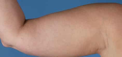 Before Image: Brachioplasty (Arm Lift) - front