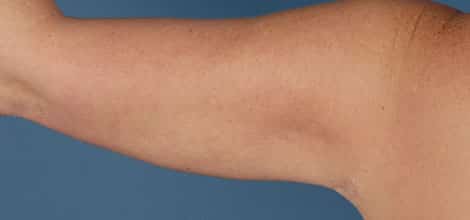 After Image: Brachioplasty (Arm Lift) - back