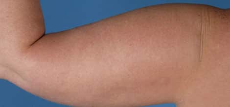 Before Image: Brachioplasty (Arm Lift) - back