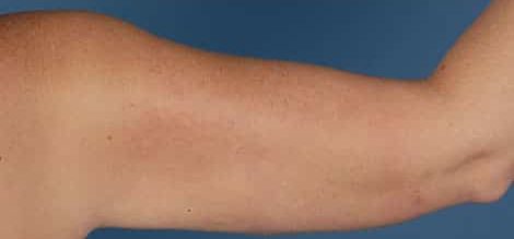 After Image: Brachioplasty (Arm Lift) - back