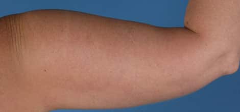 Before Image: Brachioplasty (Arm Lift) - back