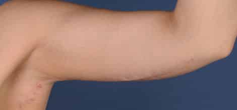 After Image: Brachioplasty (Arm Lift) - front