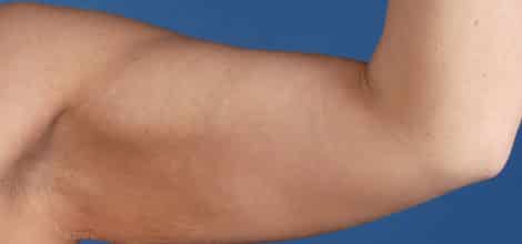 Before Image: Brachioplasty (Arm Lift) - front