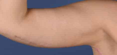 After Image: Brachioplasty (Arm Lift) - front