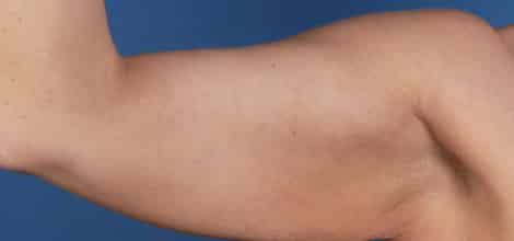 Before Image: Brachioplasty (Arm Lift) - front