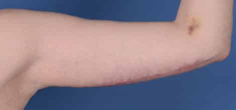 After Image: Brachioplasty (Arm Lift) - front