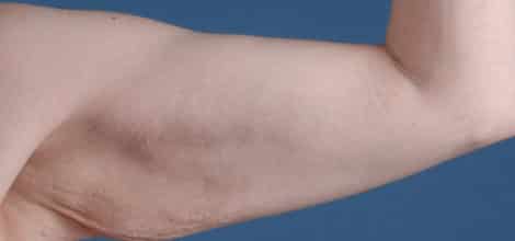 Before Image: Brachioplasty (Arm Lift) - front