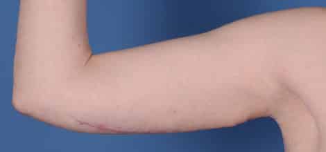 After Image: Brachioplasty (Arm Lift) - front