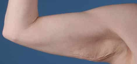 Before Image: Brachioplasty (Arm Lift) - front