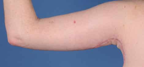 After Image: Brachioplasty (Arm Lift) - back