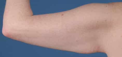 Before Image: Brachioplasty (Arm Lift) - back