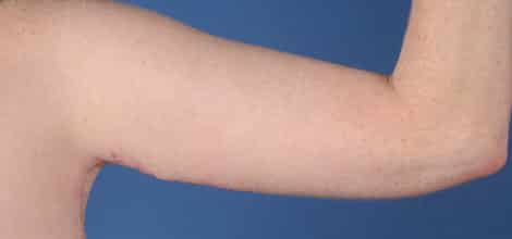 After Image: Brachioplasty (Arm Lift) - back