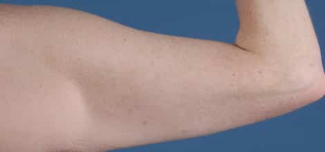 Before Image: Brachioplasty (Arm Lift) - back