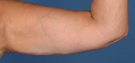 After Image: Brachioplasty (Arm Lift) - front