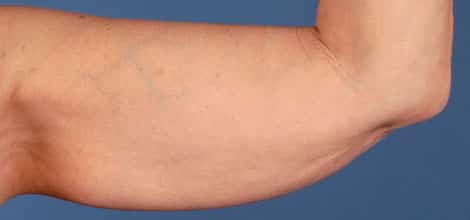 Before Image: Brachioplasty (Arm Lift) - front