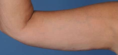 After Image: Brachioplasty (Arm Lift) - front