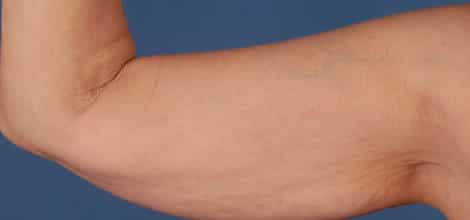 Before Image: Brachioplasty (Arm Lift) - front