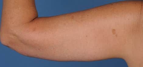 After Image: Brachioplasty (Arm Lift) - back