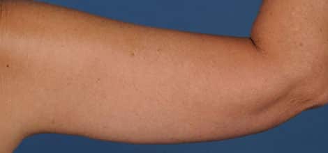 After Image: Brachioplasty (Arm Lift) - back