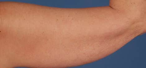 Before Image: Brachioplasty (Arm Lift) - back