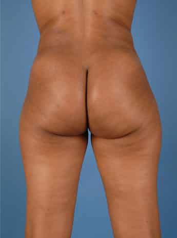 After Image: Liposuction - back