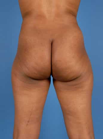Before Image: Liposuction - back