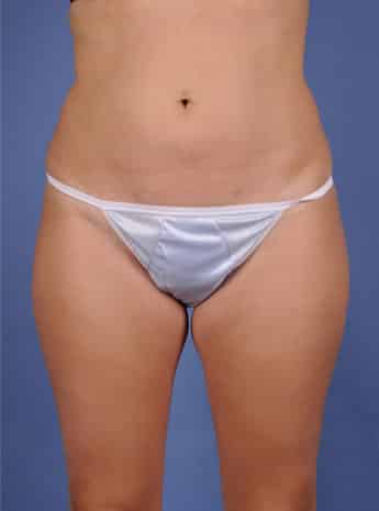 Liposuction – Case 2