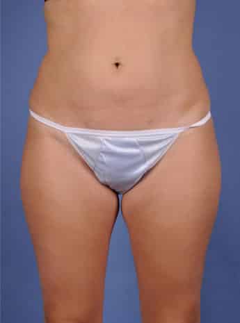 After Image: Liposuction – Case 2 - front