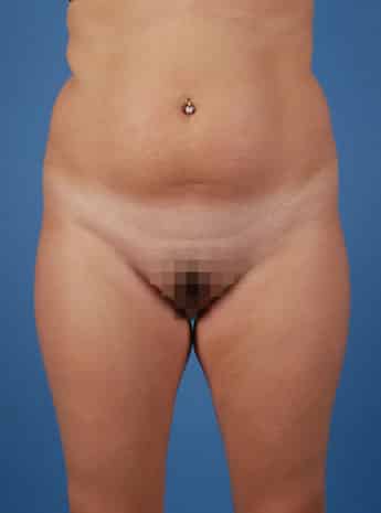 Before Image: Liposuction – Case 2 - front