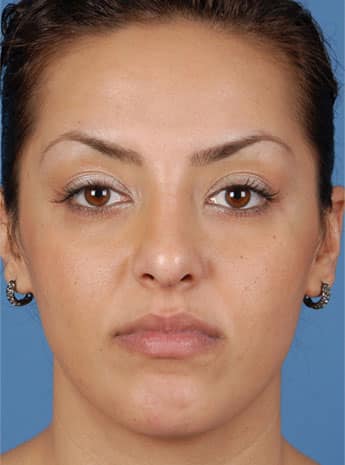 After Image: Primary Rhinoplasty - front